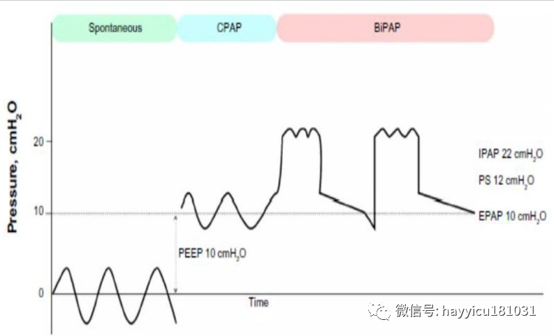 avaps模式怎么读无创正压通气的新模式_https://www.jmylbn.com_新闻资讯_第2张