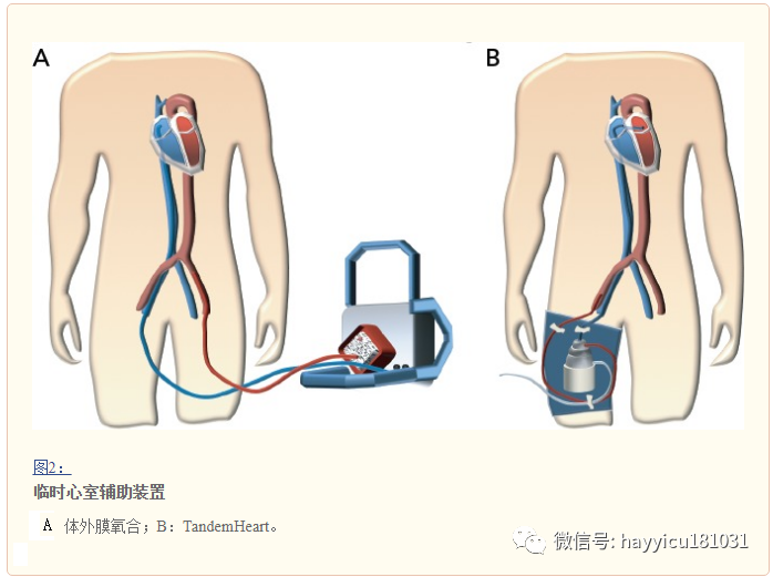 静脉治疗设备有哪些急性心力衰竭的临时性机械循环支持治疗_https://www.jmylbn.com_新闻资讯_第4张