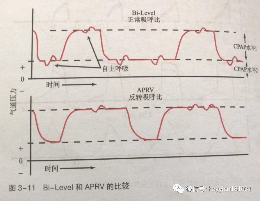 呼吸机怎么读卡各种通气模式波形汇总及其解读【收藏】_https://www.jmylbn.com_新闻资讯_第11张