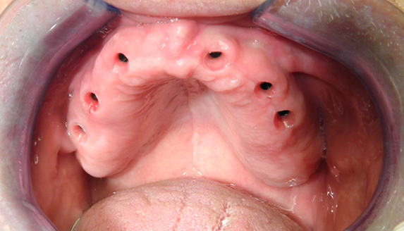 病例分享 | 椅旁高效的无牙颌即刻修复技术,准确舒适一步到位!