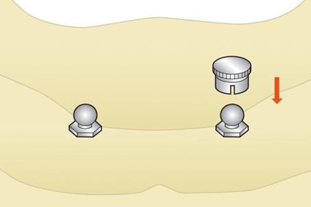 ankylos种植系统locator基台和球帽基台修复指南 - 茵伯特