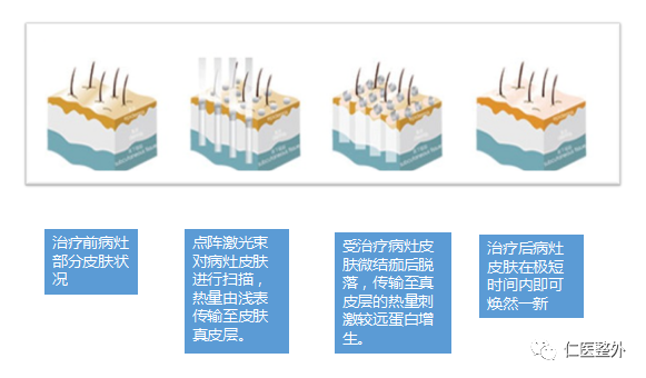 二氧化碳(co2)激光治疗是什么超脉冲二氧化碳点阵激光治疗_https://www.jmylbn.com_新闻资讯_第3张