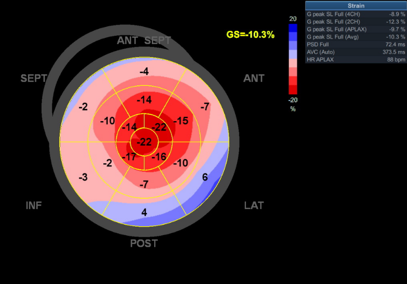 d-spect怎么检查厦门大学附属心血管病医院应用D-SPECT筛查出突变型心肌淀粉样变家系_https://www.jmylbn.com_新闻资讯_第4张
