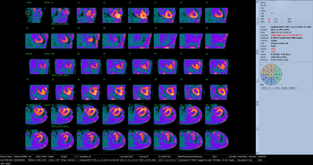 d-spect怎么检查厦门大学附属心血管病医院应用D-SPECT筛查出突变型心肌淀粉样变家系_https://www.jmylbn.com_新闻资讯_第9张