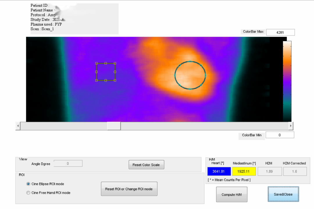 d-spect怎么检查厦门大学附属心血管病医院应用D-SPECT筛查出突变型心肌淀粉样变家系_https://www.jmylbn.com_新闻资讯_第11张