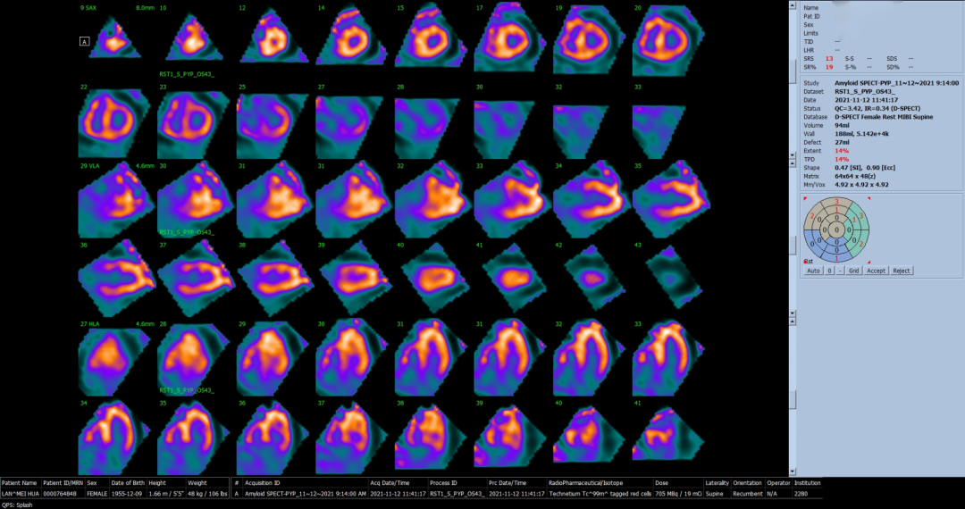 d-spect怎么检查厦门大学附属心血管病医院应用D-SPECT筛查出突变型心肌淀粉样变家系_https://www.jmylbn.com_新闻资讯_第10张