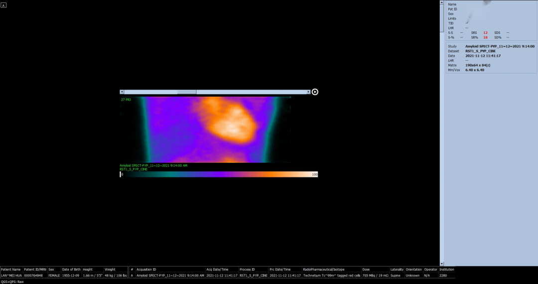 d-spect怎么检查厦门大学附属心血管病医院应用D-SPECT筛查出突变型心肌淀粉样变家系_https://www.jmylbn.com_新闻资讯_第8张