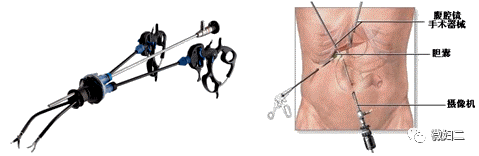 宫内镜怎么进入子宫妇科科普之内境检查技术_https://www.jmylbn.com_新闻资讯_第2张