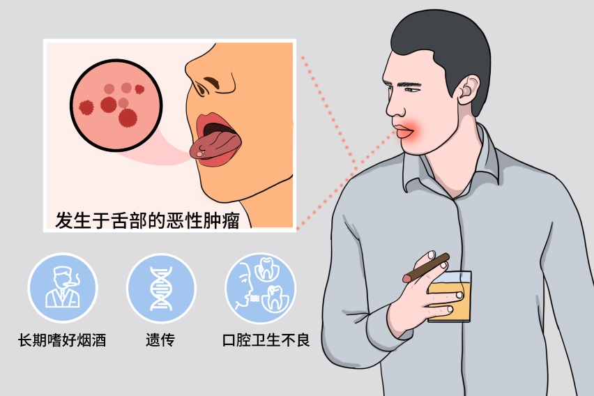 男子酷爱嚼槟榔,持续十余年得舌癌!