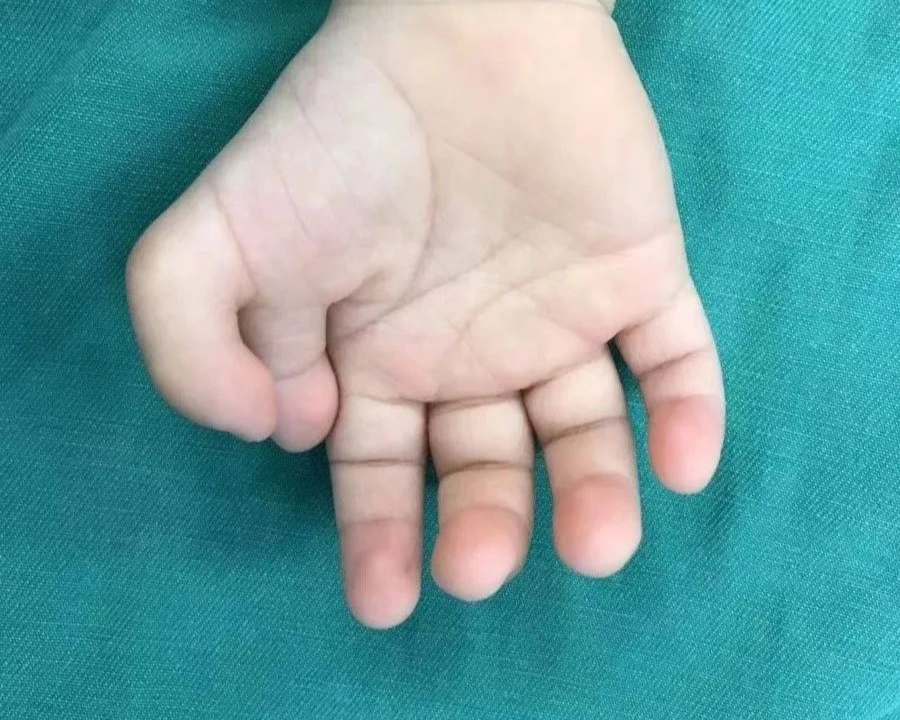 怎么区分显微剪刀天生剪刀手️——显微外科带你了解什么是多指畸形_https://www.jmylbn.com_新闻资讯_第10张
