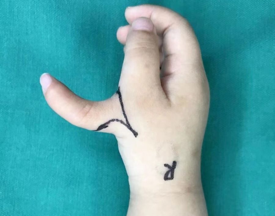 怎么区分显微剪刀天生剪刀手️——显微外科带你了解什么是多指畸形_https://www.jmylbn.com_新闻资讯_第11张