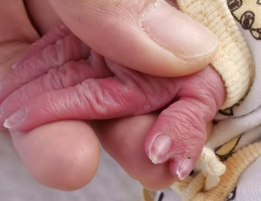 怎么区分显微剪刀天生剪刀手️——显微外科带你了解什么是多指畸形_https://www.jmylbn.com_新闻资讯_第9张