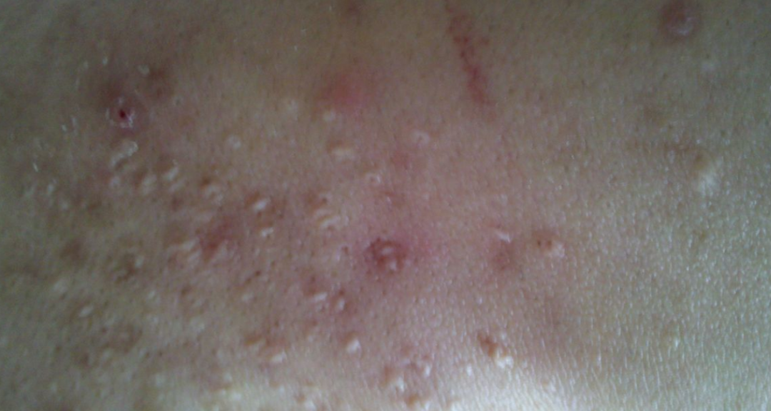 深圳皮肤科医院哪个好_抠头皮总能抠出小颗粒？千万要当心这几种头皮疾病！_深圳看皮肤病的专科