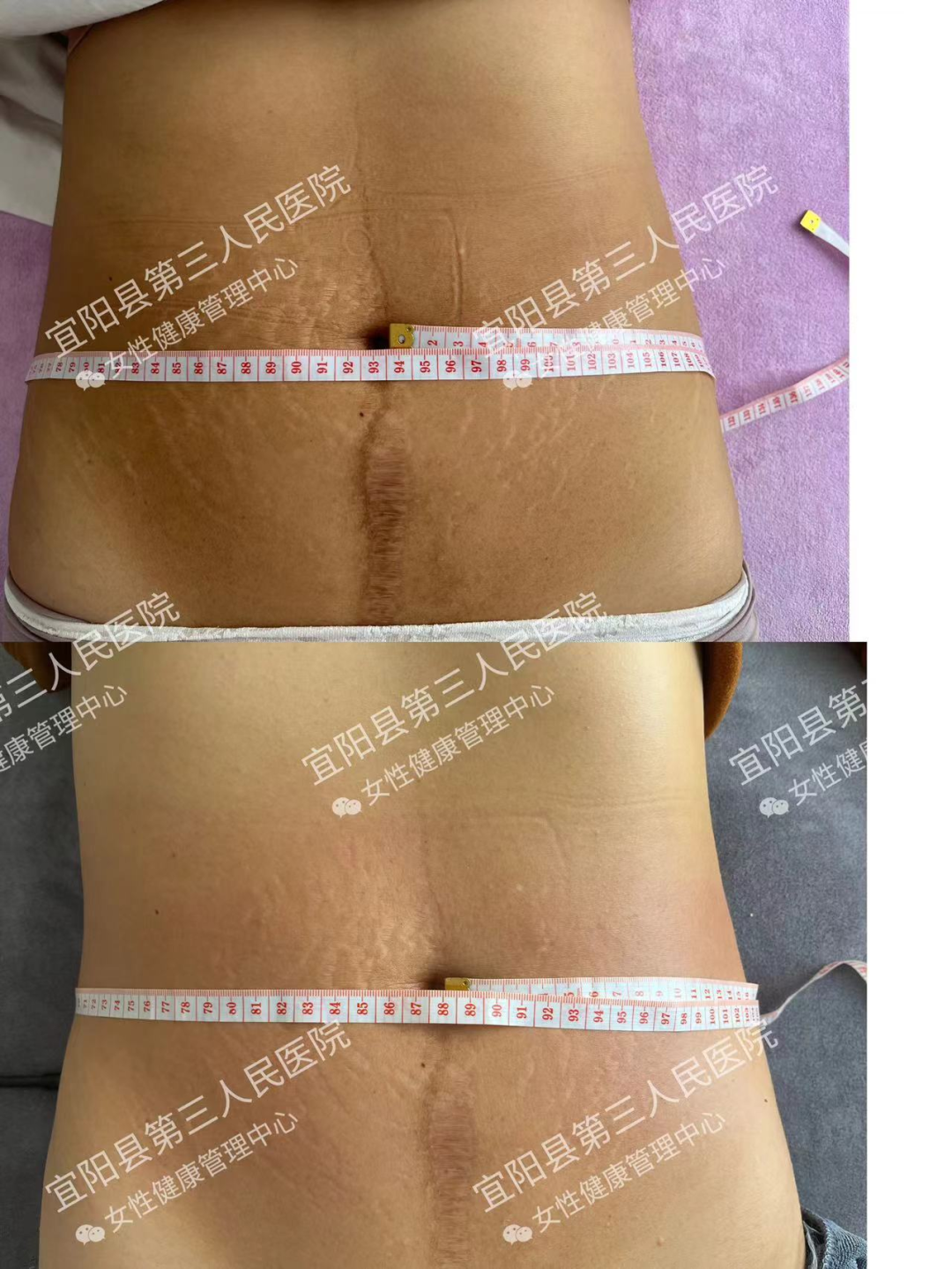 什么是理疗仪身体塑形、缓解疼痛…“黑科技”射频理疗仪，满足更多女性康复需求_https://www.jmylbn.com_新闻资讯_第13张