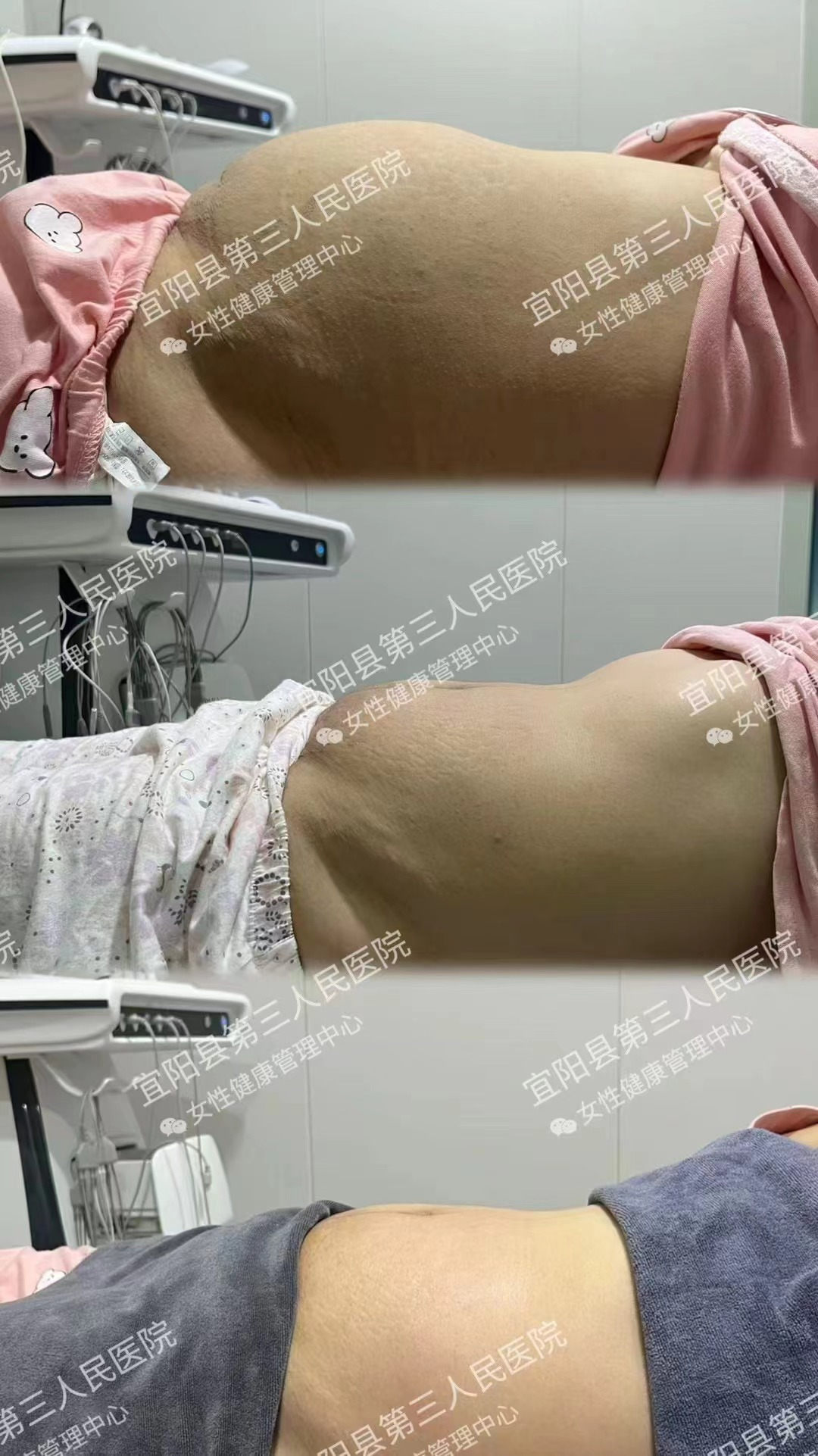 什么是理疗仪身体塑形、缓解疼痛…“黑科技”射频理疗仪，满足更多女性康复需求_https://www.jmylbn.com_新闻资讯_第12张