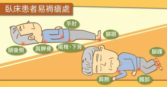 vsd引流怎么拔出VSD封闭式负压引流技术，压疮患者的福音_https://www.jmylbn.com_新闻资讯_第4张