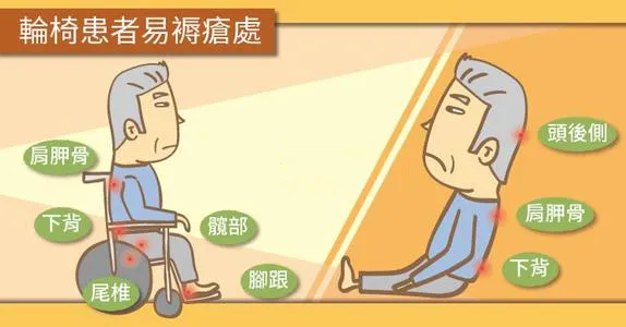 vsd引流怎么拔出VSD封闭式负压引流技术，压疮患者的福音_https://www.jmylbn.com_新闻资讯_第3张