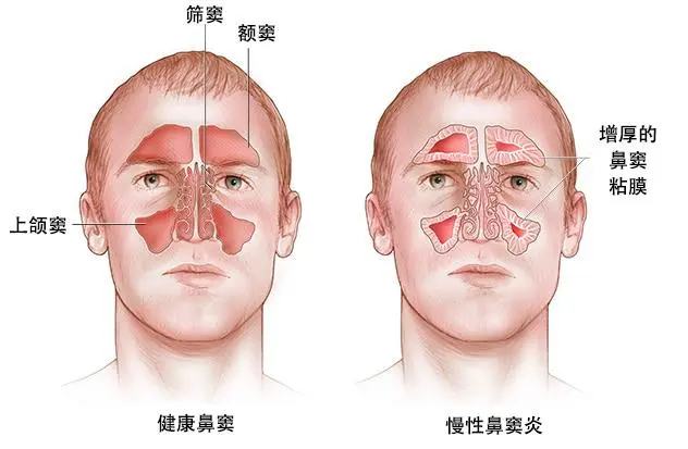 鼻窦炎、慢性鼻窦炎在儿科是一种比较常见的疾病，这种鼻部疾病在秋冬季