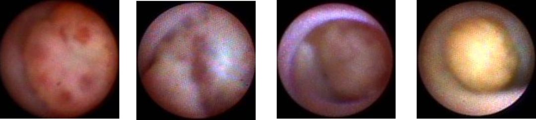 乳腺导管内窥镜图片