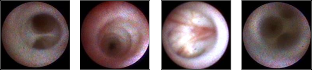 右乳导管内乳头状瘤图片