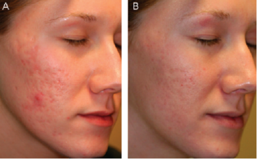 什么是光电治疗丛林学苑丨03：痤疮后红斑的光电治疗（一）_https://www.jmylbn.com_新闻资讯_第4张