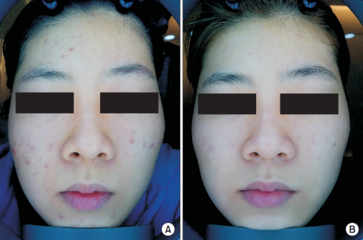 什么是光电治疗丛林学苑丨03：痤疮后红斑的光电治疗（一）_https://www.jmylbn.com_新闻资讯_第5张