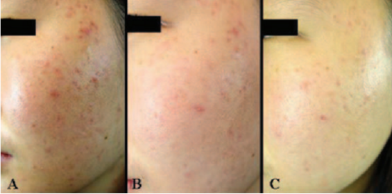 什么是光电治疗丛林学苑丨03：痤疮后红斑的光电治疗（一）_https://www.jmylbn.com_新闻资讯_第3张