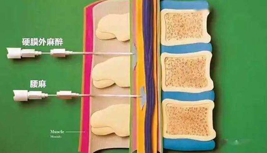 怎么知道穿刺到硬膜外麻醉视角丨腰硬联合麻醉的“另类”注意事项，你知道几点？_https://www.jmylbn.com_新闻资讯_第1张