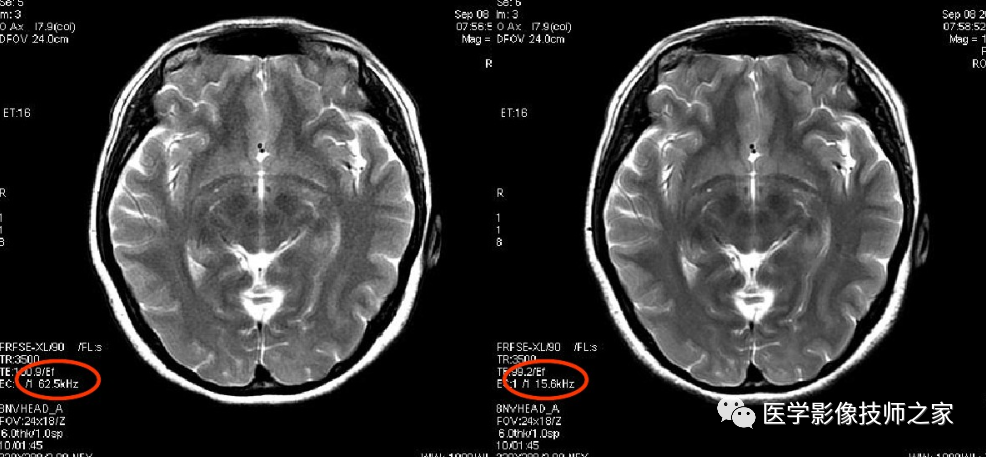 磁共振矩阵怎么计算作为一名合格的磁共振技师，你所必须熟知的技术参数_https://www.jmylbn.com_新闻资讯_第17张