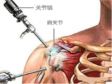 关节镜配套哪些将膝关节“镜”行到底_https://www.jmylbn.com_新闻资讯_第3张