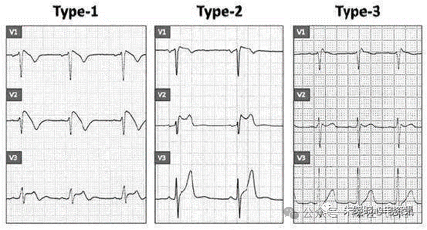 ST段抬高的识别及相关疾病的鉴别，这篇文章给你讲清楚了！