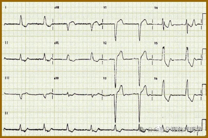 ST段抬高的识别及相关疾病的鉴别，这篇文章给你讲清楚了！