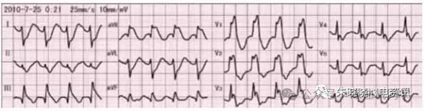 ST段抬高的识别及相关疾病的鉴别，这篇文章给你讲清楚了！
