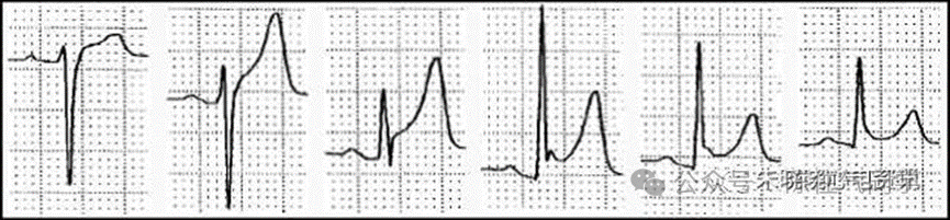 ST段抬高的识别及相关疾病的鉴别，这篇文章给你讲清楚了！
