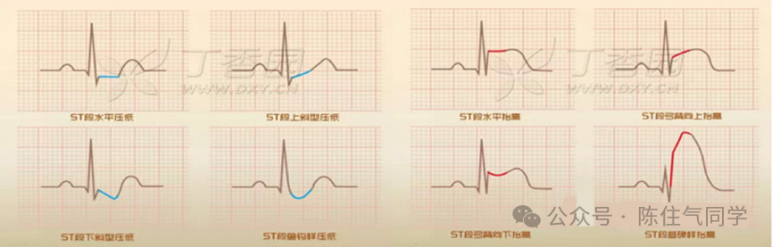 ST段抬高的识别及相关疾病的鉴别，这篇文章给你讲清楚了！