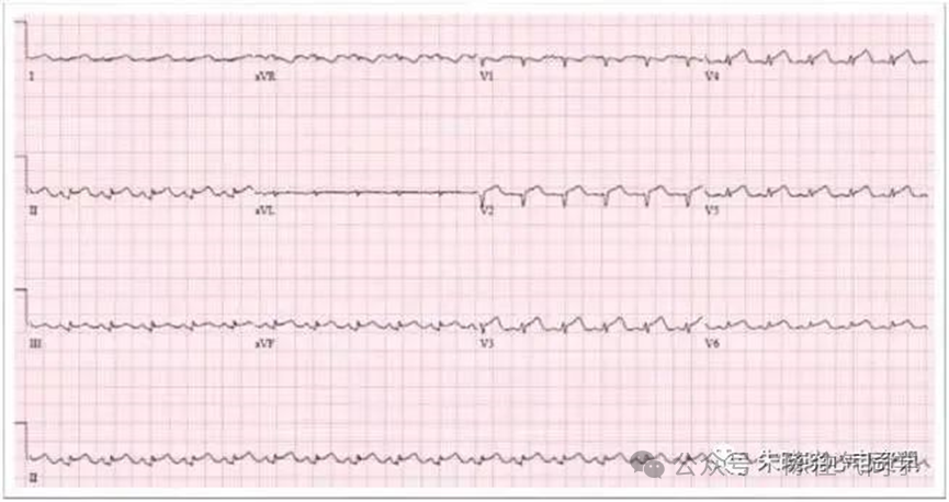 ST段抬高的识别及相关疾病的鉴别，这篇文章给你讲清楚了！