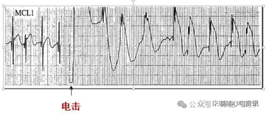 ST段抬高的识别及相关疾病的鉴别，这篇文章给你讲清楚了！