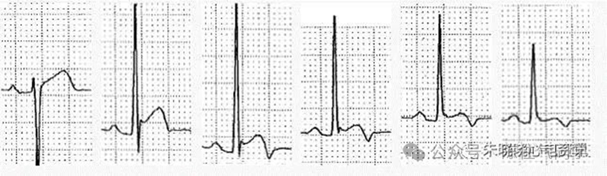 ST段抬高的识别及相关疾病的鉴别，这篇文章给你讲清楚了！