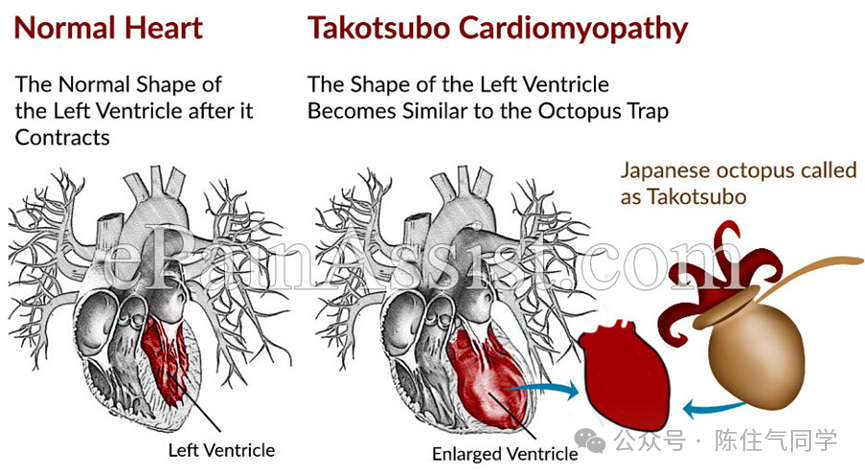 ST段抬高的识别及相关疾病的鉴别，这篇文章给你讲清楚了！