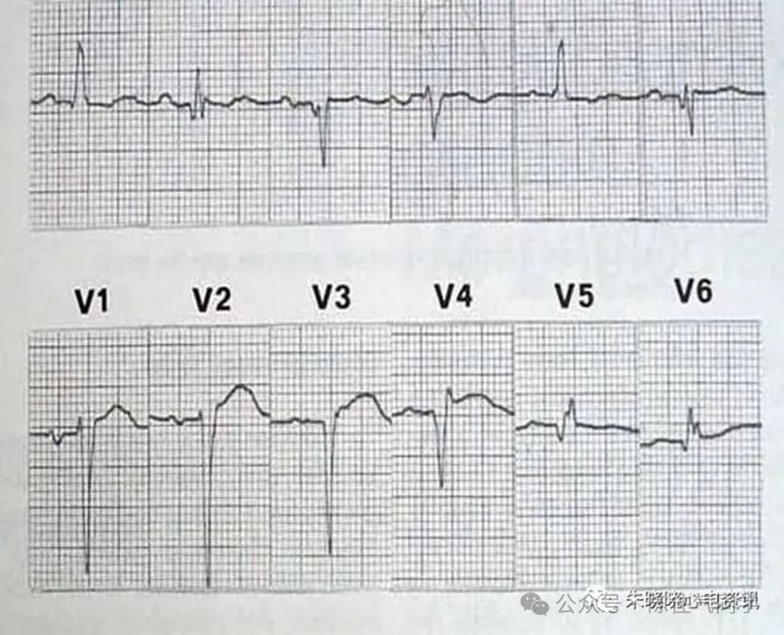 ST段抬高的识别及相关疾病的鉴别，这篇文章给你讲清楚了！