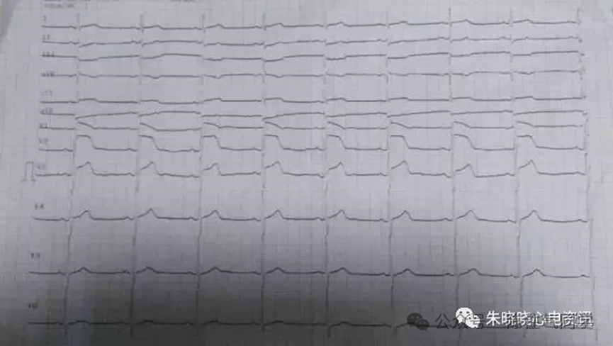 ST段抬高的识别及相关疾病的鉴别，这篇文章给你讲清楚了！