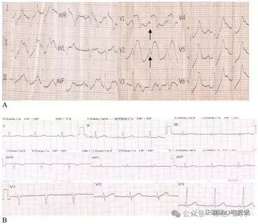 ST段抬高的识别及相关疾病的鉴别，这篇文章给你讲清楚了！