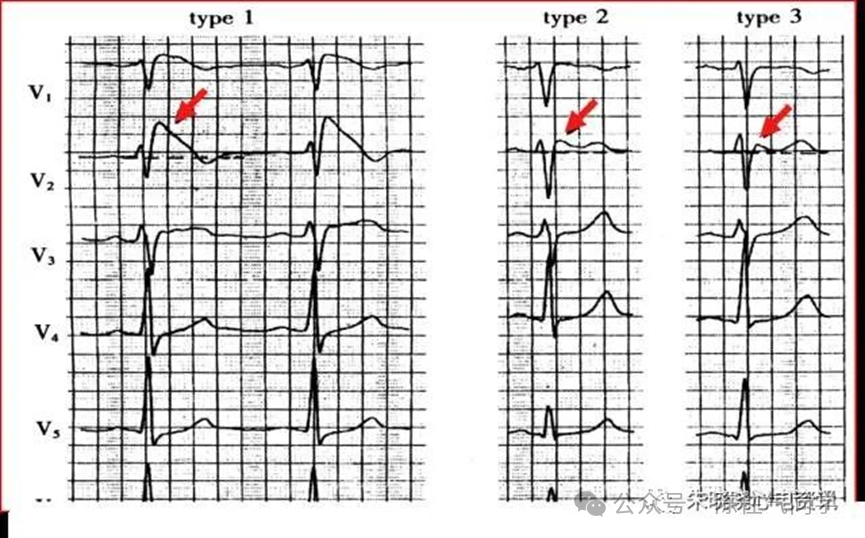 ST段抬高的识别及相关疾病的鉴别，这篇文章给你讲清楚了！