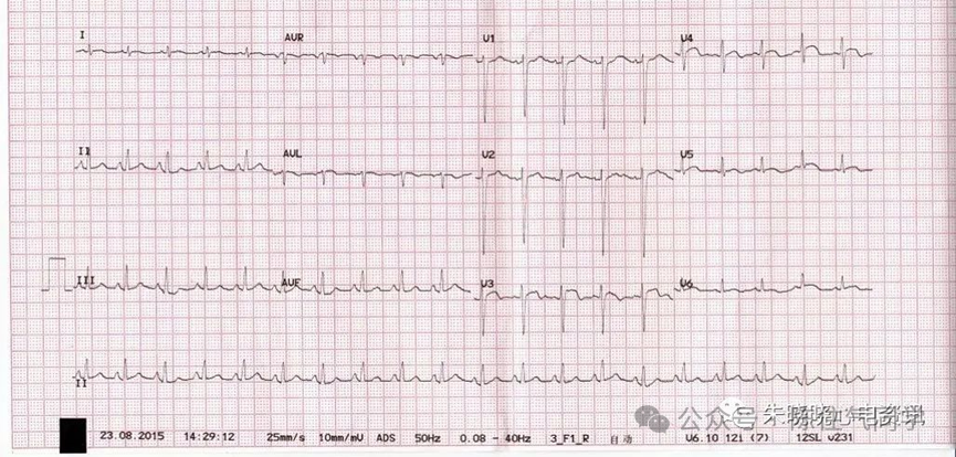 ST段抬高的识别及相关疾病的鉴别，这篇文章给你讲清楚了！