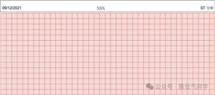 动态心电图怎么分析动态心电图的规范化分析和诊断_https://www.jmylbn.com_新闻资讯_第16张