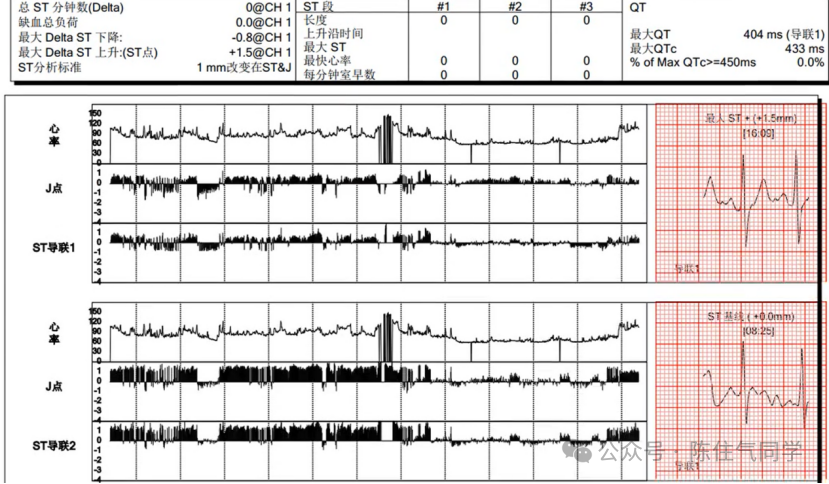 动态心电图怎么分析动态心电图的规范化分析和诊断_https://www.jmylbn.com_新闻资讯_第17张