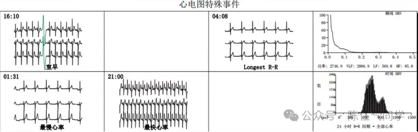 动态心电图怎么分析动态心电图的规范化分析和诊断_https://www.jmylbn.com_新闻资讯_第12张