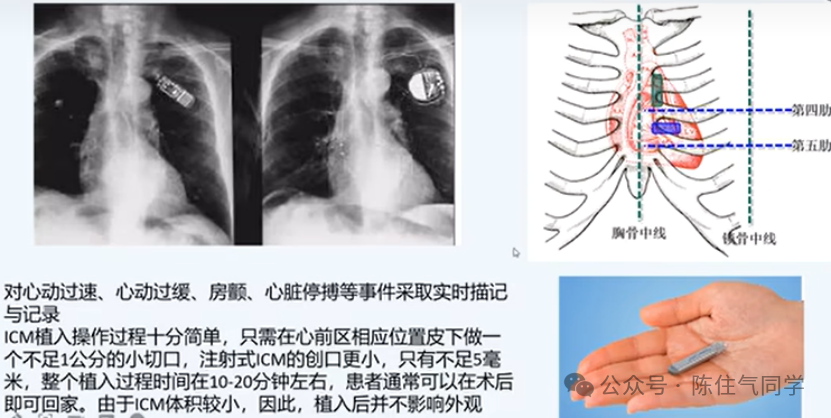 动态心电图怎么分析动态心电图的规范化分析和诊断_https://www.jmylbn.com_新闻资讯_第4张