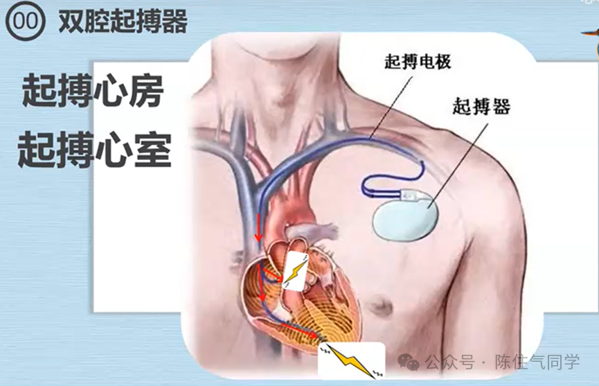 心电图器怎么用起搏器入门，简单易懂！_https://www.jmylbn.com_新闻资讯_第16张