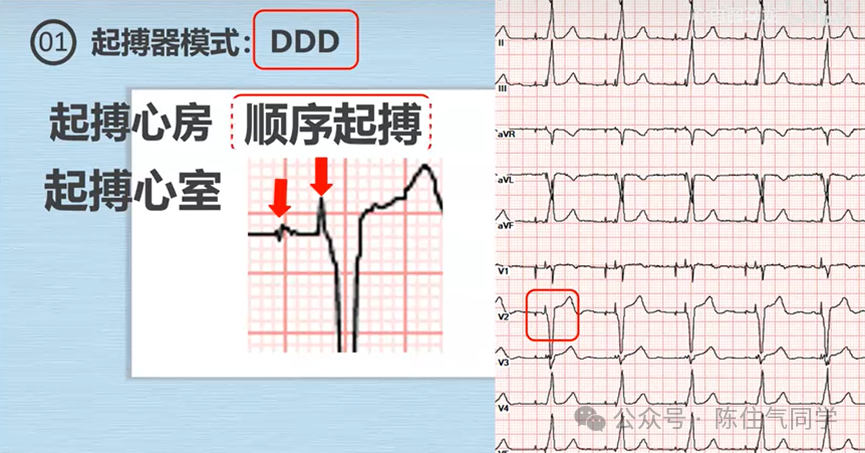 心电图器怎么用起搏器入门，简单易懂！_https://www.jmylbn.com_新闻资讯_第17张